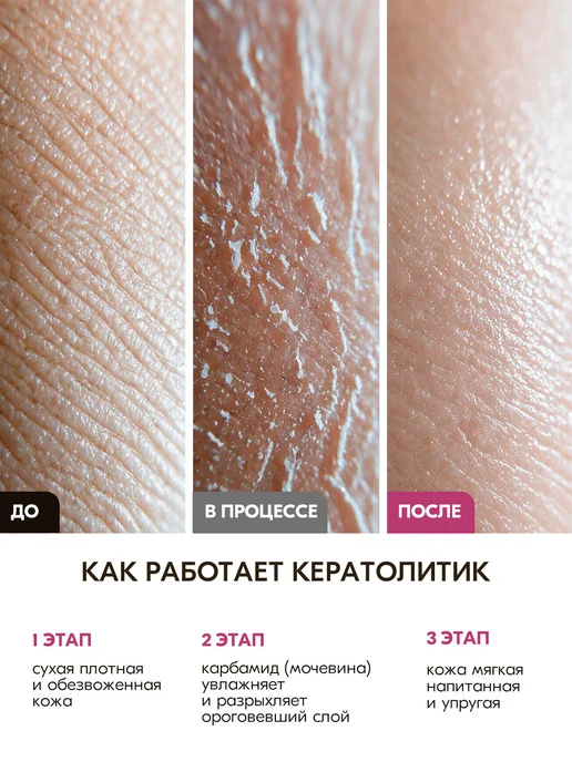 INKI Кератолитик для пяток профессиональный с мочевиной спрей, вариант, фото 5