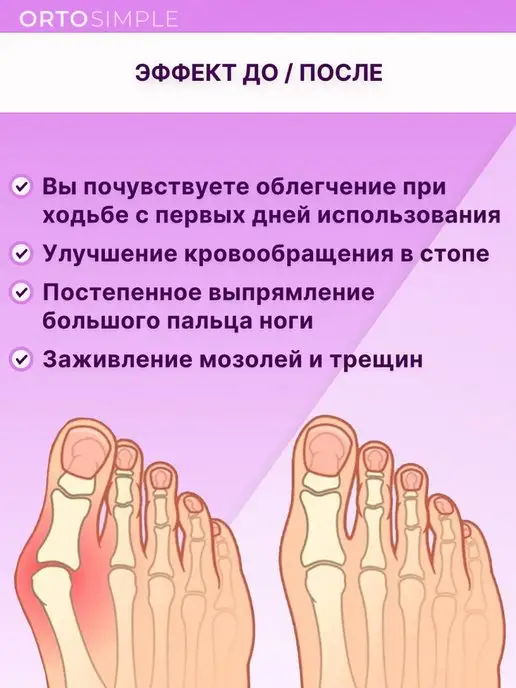ORTOSIMPLE Корректор большого пальца ноги перегородка разделитель, белый, фото 7
