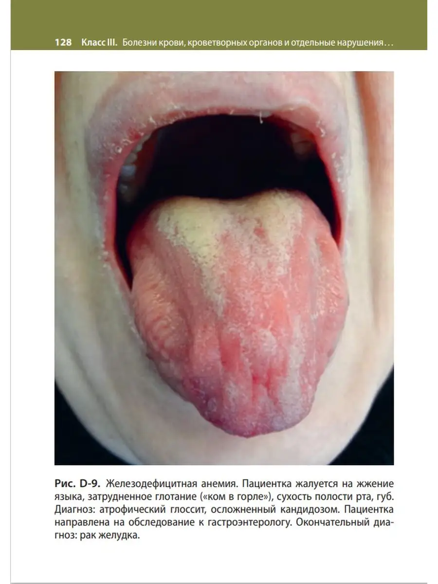 Воспаление слизистой оболочки полости рта - лечение