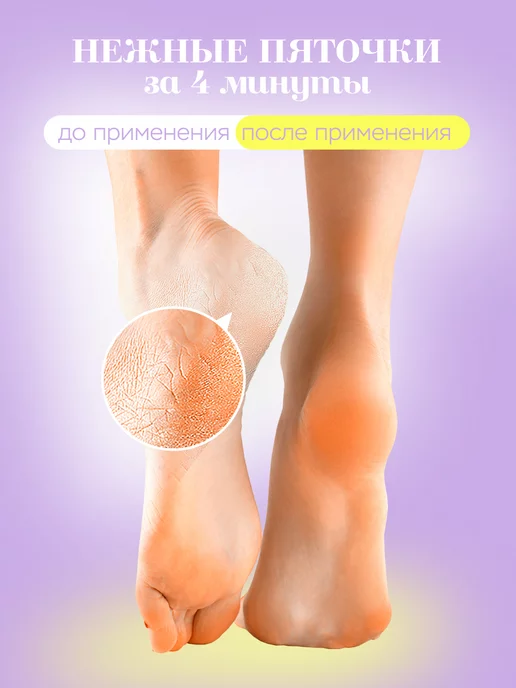 Нежные Пяточки Набор для педикюра, кератолитик и крем для ног, вариант, фото 2