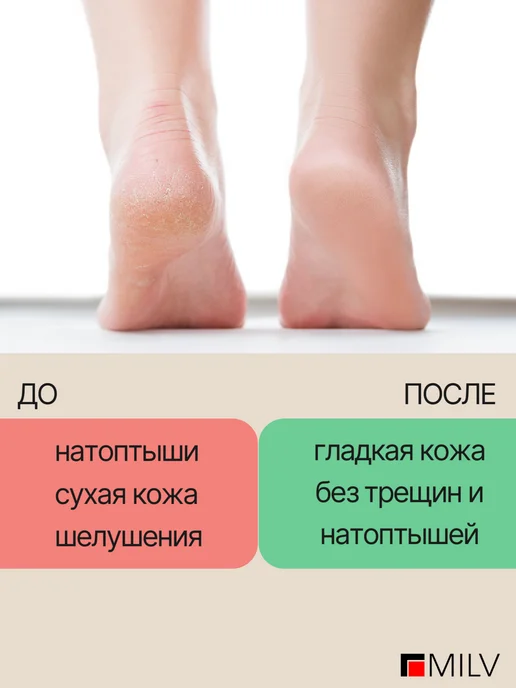 MILV Пена-кератолитик для пяток с мочевиной, вариант, фото 3